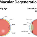 Macular Degeneration