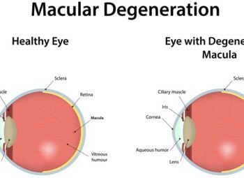 Macular Degeneration