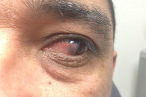 Pterygium Before