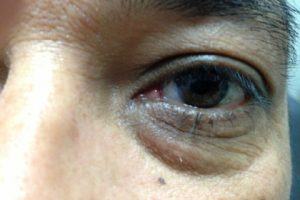 Pterygium After