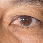 Pterygium