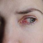 Common Eye Infections