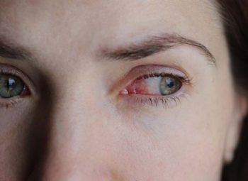 Common Eye Infections