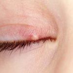 Stye On Eye