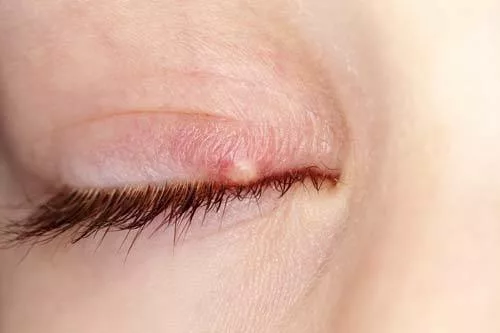 Stye On Eye