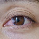 close up of the pterygium during eye examination