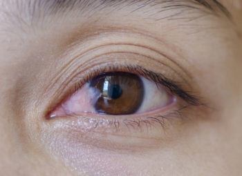 close up of the pterygium during eye examination