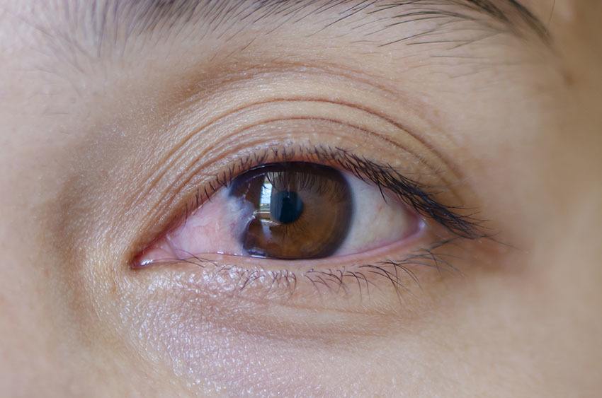 close up of the pterygium during eye examination