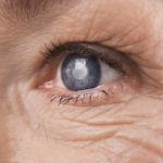 Close up of an elder womens face with a hypermature cataract in her eye