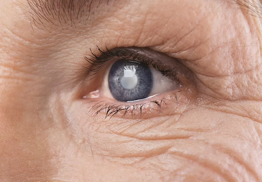 Close up of an elder womens face with a hypermature cataract in her eye