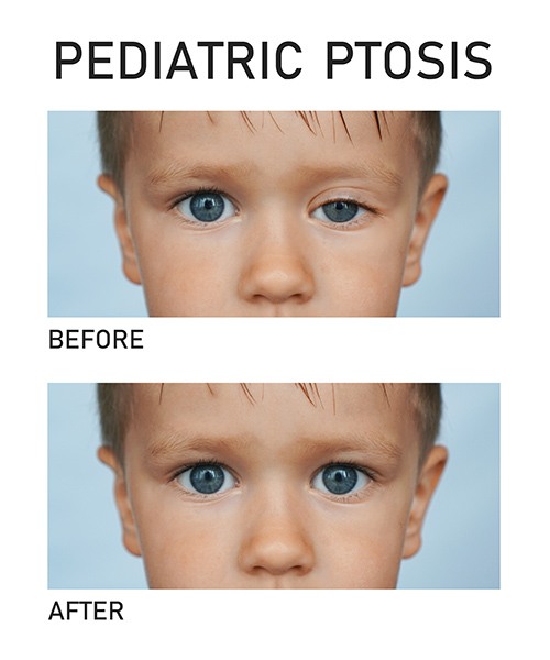 comparison of ptosis in children before and after treatment