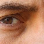 Close up of a man's face who has Ptosis, drooping upper eyelid