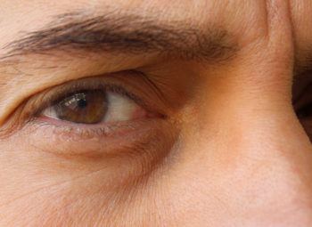 Close up of a man's face who has Ptosis, drooping upper eyelid