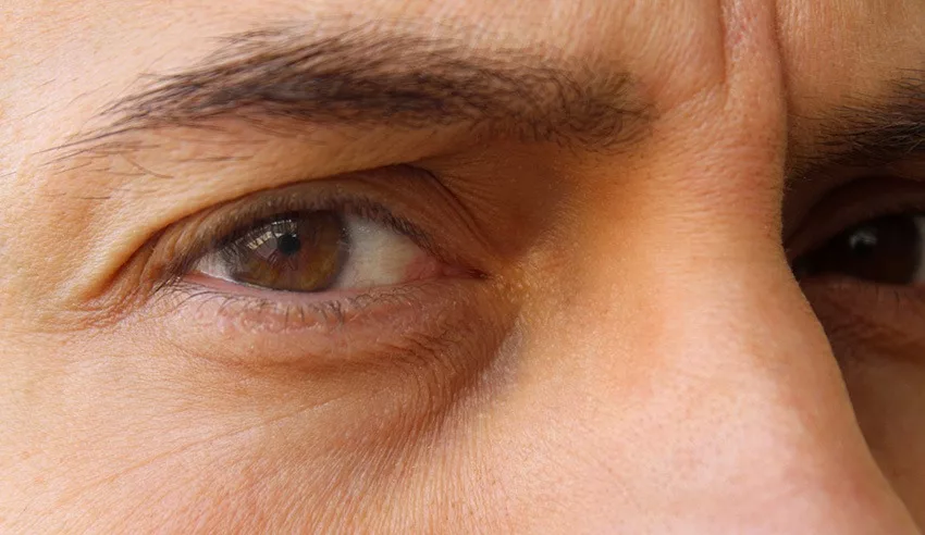 Close up of a man's face who has Ptosis, drooping upper eyelid