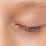 Close up of wart / skin tag on eyelid.