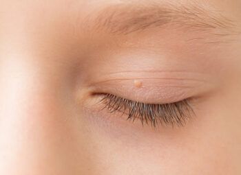 Close up of wart / skin tag on eyelid.