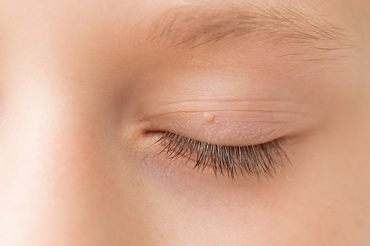 Close up of wart / skin tag on eyelid.