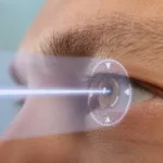 Man's upper face in profile with laser beam going to eye