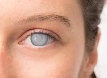 Woman's eye with cataract