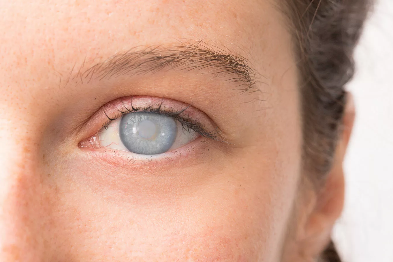 Woman's eye with cataract