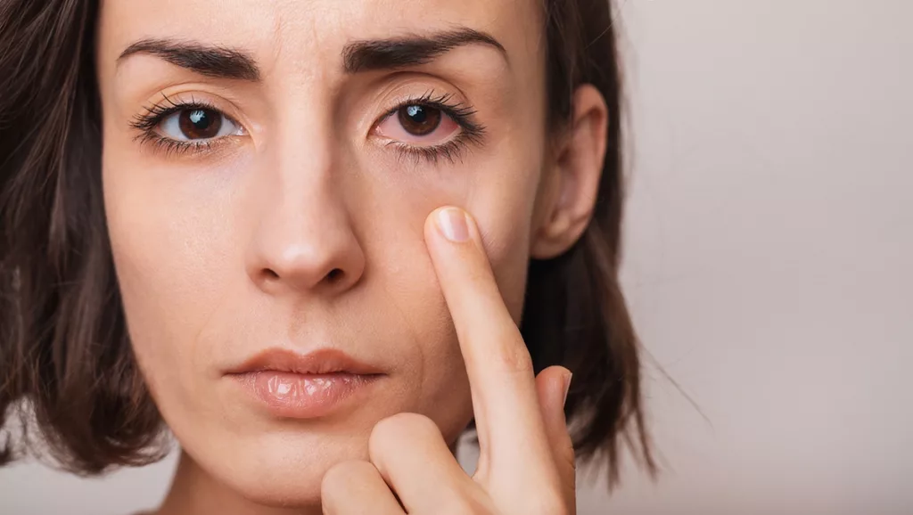 Woman points to her red and irritated eye