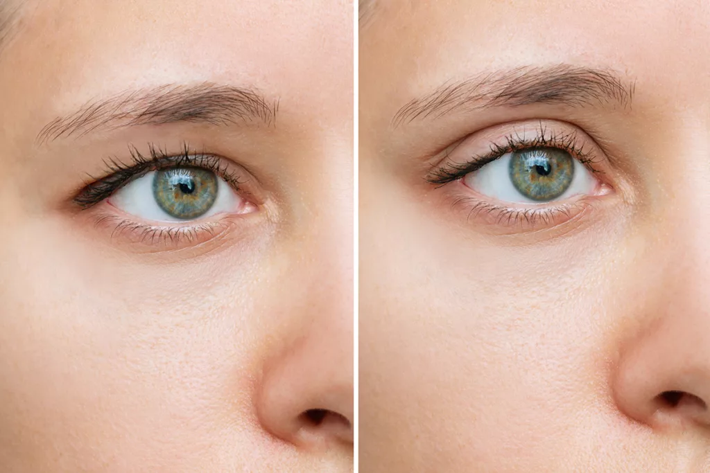 Two close up images of a young woman's eye before and after an eyelid lift (blepharoplasty) procedure.
