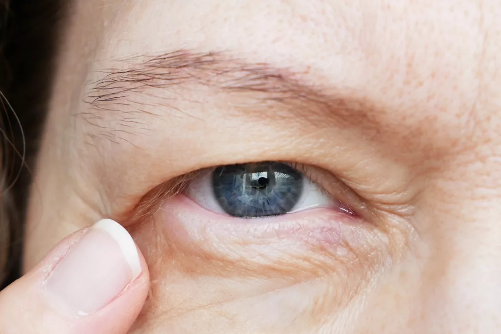 A middle-aged woman points to her droopy eyelid